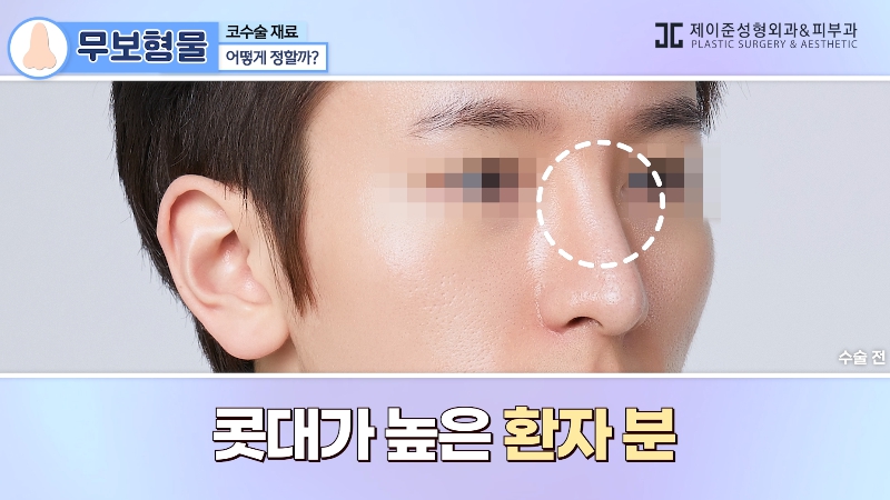 [Jayjun YouTube] Non-Implant Nose Surgery: In What Cases Is It Suitable? image 12