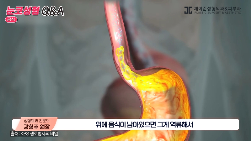 [Jeijun Plastic Surgery & Dermatology] Pre- and Post-Op Q&A: The Must-Know Guide to Eye and Nose Surgery! image 4