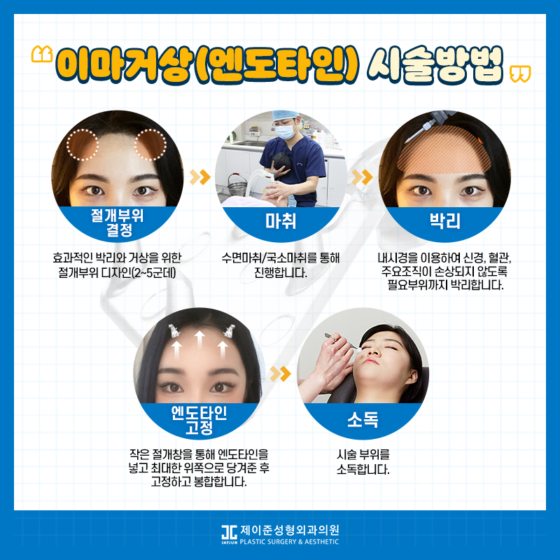 [강남눈성형] 눈성형하러갔는데 이마거상 추천하는 이유 관련 이미지 2