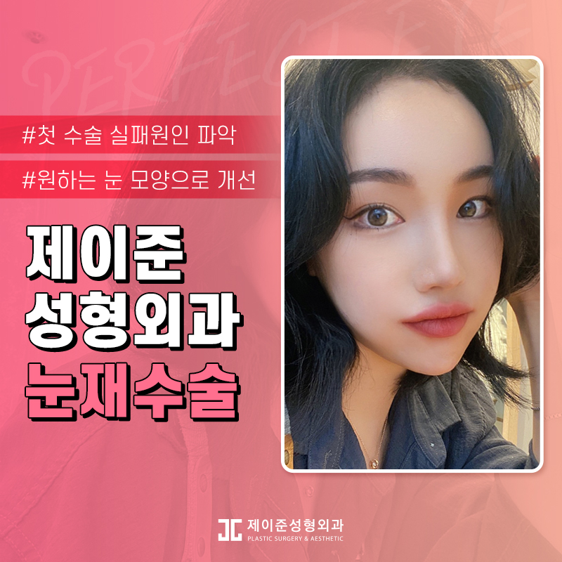 두번의 실패는 없을 제이준성형외과 눈재수술 관련 이미지 2