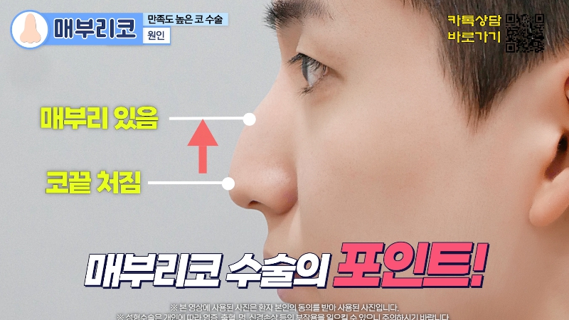 [제이준 유튜브] 유형별 코 성형, 가장 만족도 큰 매부리 코! 관련 이미지 5