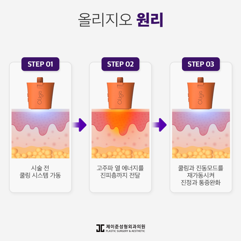 탄력잃고 처진 얼굴에는 올리지오리프팅 관련 이미지 4