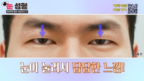 [제이준 유튜브] 눈 성형, 함께 하면 효과 좋은 수술 BEST 3! 관련 이미지 4