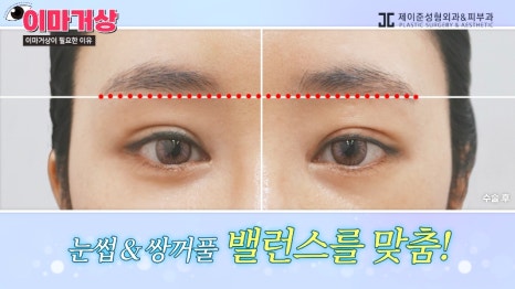 [제이준 유튜브] 쌍수 하러  갔는데 이마거상을 추천하는 이유?! 관련 이미지 10