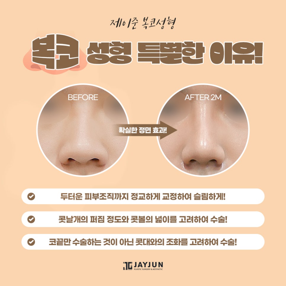 [제이준성형외과] 어떤 각도에서도 자신있는! 제이준 복코 성형 관련 이미지 4
