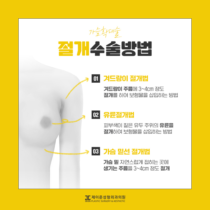 가슴확대술 어떤 수술일까요? 관련 이미지 7