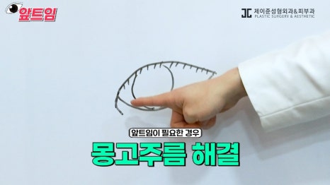 [Jaejune Plastic Surgery & Dermatology] Why is epicanthoplasty necessary? Everything about epicanthoplasty!! image 15