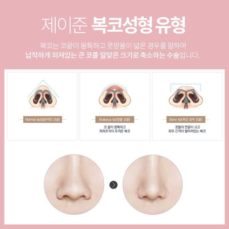 [제이준 성형외과] 복코성형을 자연스럽고 세련되게 하려면? 관련 이미지 3