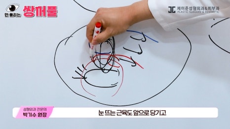[제이준성형외과&middot;피부과] 쌍꺼풀 수술 vs 쌍꺼풀+눈매교정! 눈매교정 함께 하면 좋은 이유! 관련 이미지 8