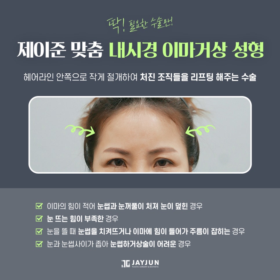 [제이준 성형외과] 미용+기능 동시에 잡는 제이준 중년 눈성형 관련 이미지 6