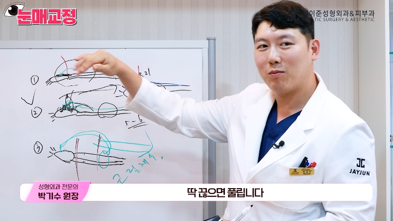 [제이준성형외과&middot;피부과] 눈매교정 파헤치기! 하나부터 열까지 싹~ 알려드립니다! 관련 이미지 11