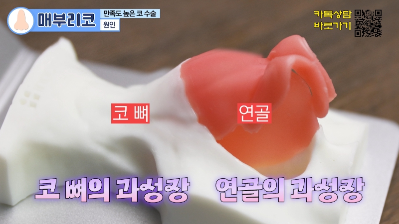 [제이준 유튜브] 유형별 코 성형, 가장 만족도 큰 매부리 코! 관련 이미지 4