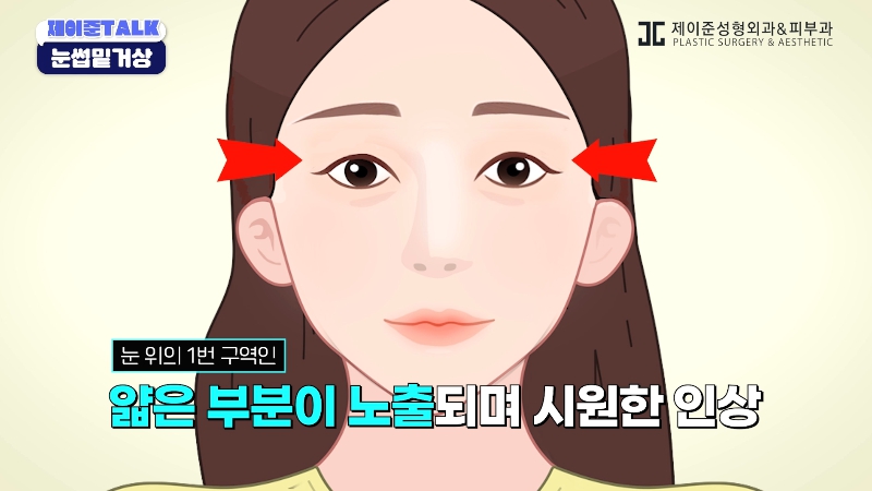 [Jaejune Plastic Surgery & Dermatology] The Secret to a Cleaner Eye Area Without Looking Obvious. #BrowboneLift image 7