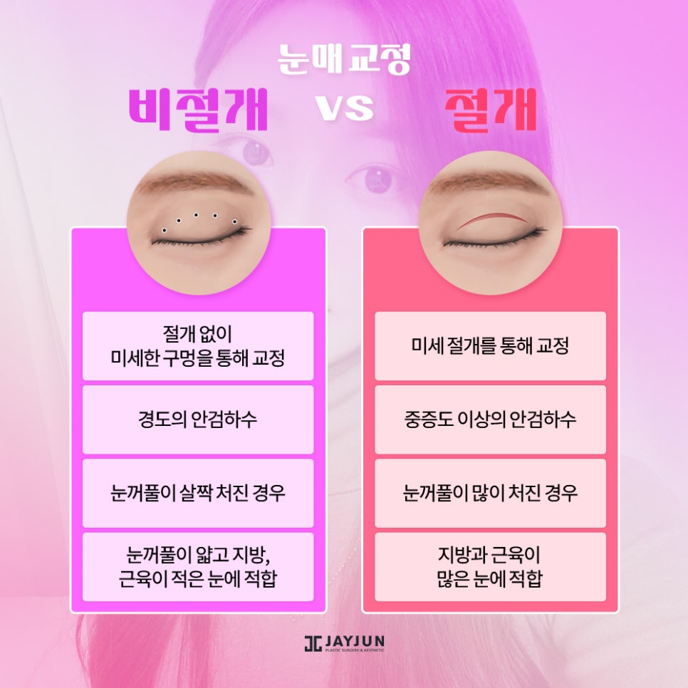 생기있고! 또렷하게! 제이준 눈매교정 관련 이미지 5
