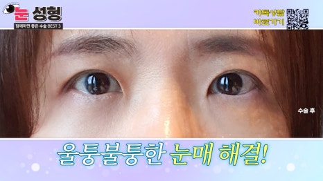 [제이준 유튜브] 눈 성형, 함께 하면 효과 좋은 수술 BEST 3! 관련 이미지 12