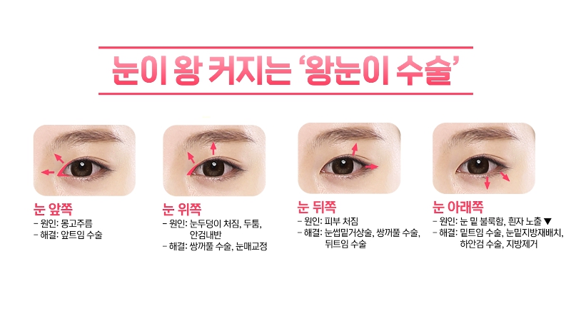 [제이준성형외과&middot;피부과] 제이준성형외과 박철흠 원장님이 알려주는 눈이 커지는 방법 핵심요약! 관련 이미지 28