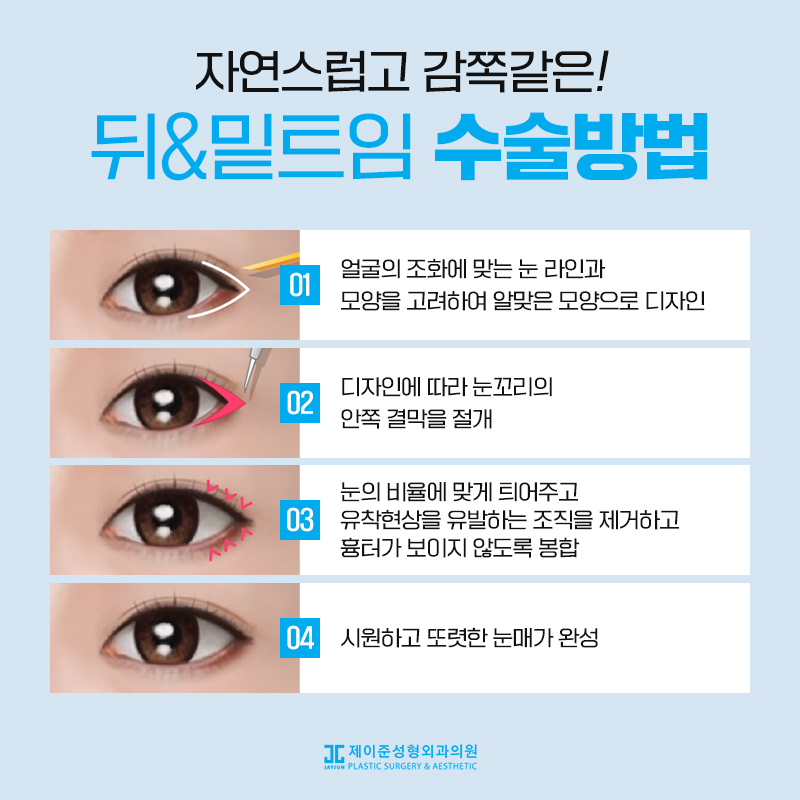 뒤트임과 밑트임이란? 관련 이미지 4