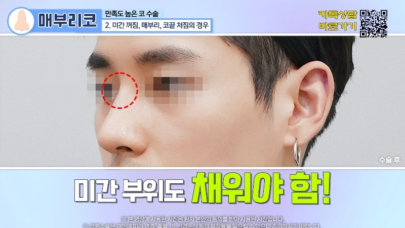 [제이준 유튜브] 유형별 코 성형, 가장 만족도 큰 매부리 코! 관련 이미지 9