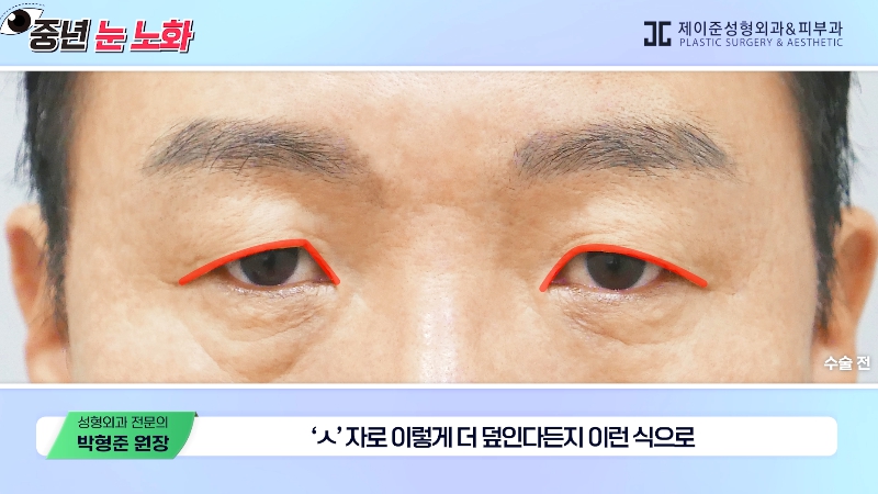 [제이준성형외과&middot;피부과] 🚨성형외과 전문의가 알려주는 눈 노화 신호🚨 관련 이미지 10