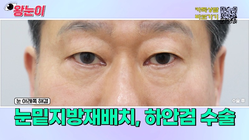 [제이준성형외과&middot;피부과] 제이준성형외과 박철흠 원장님이 알려주는 눈이 커지는 방법 핵심요약! 관련 이미지 27