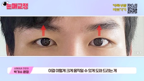 [제이준성형외과&middot;피부과] 눈매교정 파헤치기! 하나부터 열까지 싹~ 알려드립니다! 관련 이미지 3