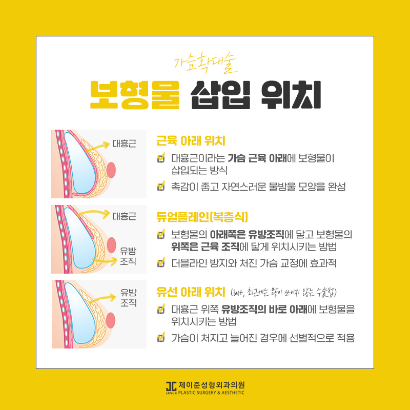 가슴확대술 어떤 수술일까요? 관련 이미지 8