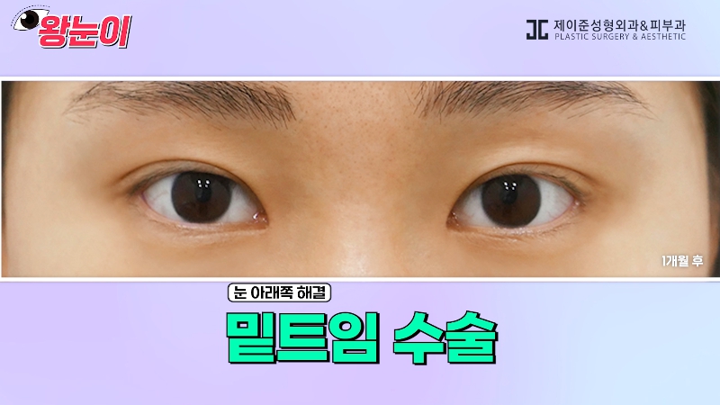 [제이준성형외과&middot;피부과] 제이준성형외과 박철흠 원장님이 알려주는 눈이 커지는 방법 핵심요약! 관련 이미지 26