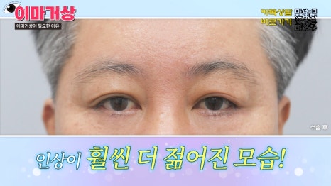 [제이준 유튜브] 쌍수 하러  갔는데 이마거상을 추천하는 이유?! 관련 이미지 6