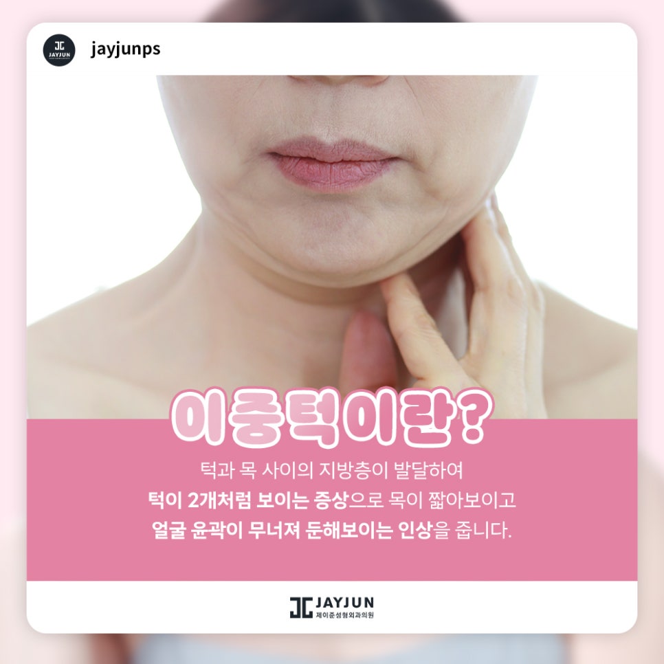 한번에 확실하게! 제이준 이중턱 지방흡입 & 근육묶기 관련 이미지 2