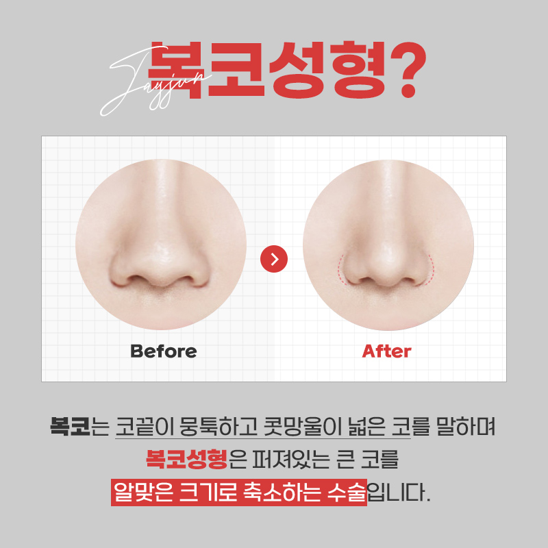 뭉툭한 복코를 개선하는 제이준 복코성형 관련 이미지 2