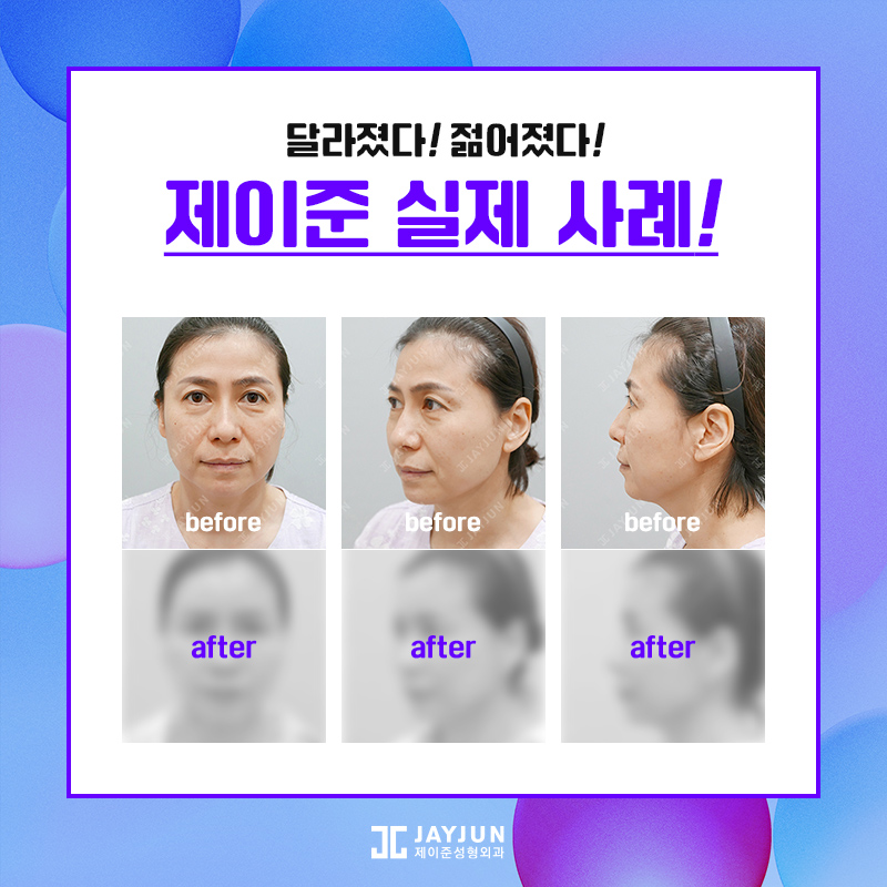 제이준성형외과 안면거상술 , SMAS층까지 당겨야 효과 좋아 관련 이미지 7