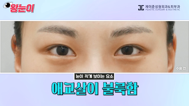 [제이준성형외과&middot;피부과] 제이준성형외과 박철흠 원장님이 알려주는 눈이 커지는 방법 핵심요약! 관련 이미지 22