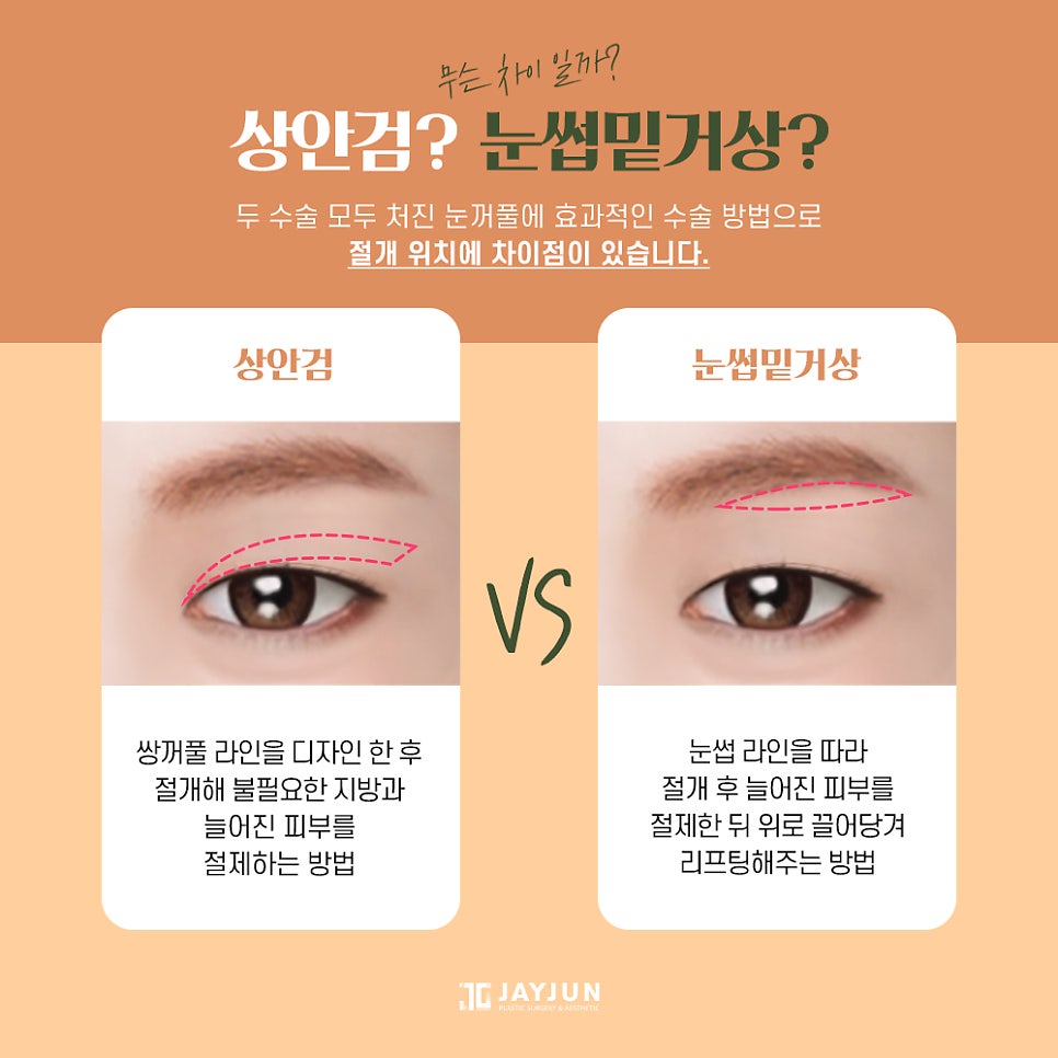 [제이준성형외과] 주름개선과 동안눈매를 한번에! 중년눈성형 눈썹밑거상 관련 이미지 7