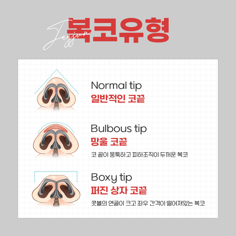 뭉툭한 복코를 개선하는 제이준 복코성형 관련 이미지 3