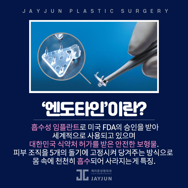 제이준성형외과│내시경 엔도타인 이마거상술은 오화영 원장님과 함께 관련 이미지 5