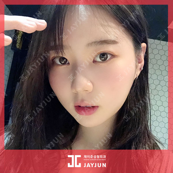제이준피부과, 강남 입술필러 용량이 무제한이라고?! 관련 이미지 4