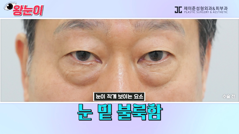 [제이준성형외과&middot;피부과] 제이준성형외과 박철흠 원장님이 알려주는 눈이 커지는 방법 핵심요약! 관련 이미지 23