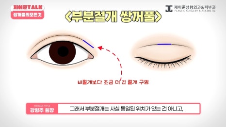 [제이준성형외과&middot;피부과] 비절개&middot;부분절개&middot;절개 쌍꺼풀의 원리와 차이점! 관련 이미지 13