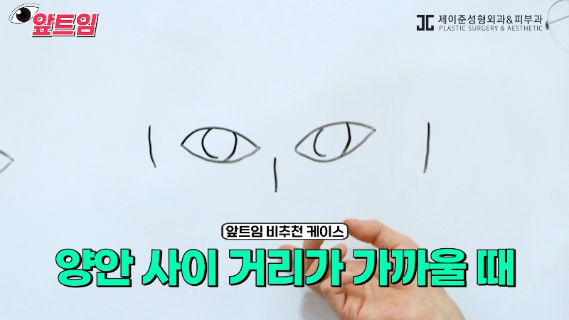 [Jaejune Plastic Surgery & Dermatology] Why is epicanthoplasty necessary? Everything about epicanthoplasty!! image 24