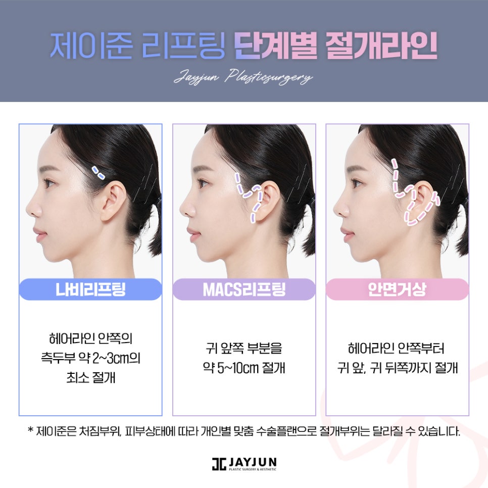 #중안면부 #나비존 #최소절개리프팅 제이준 나비리프팅 관련 이미지 6