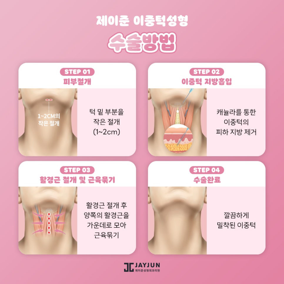 한번에 확실하게! 제이준 이중턱 지방흡입 & 근육묶기 관련 이미지 7
