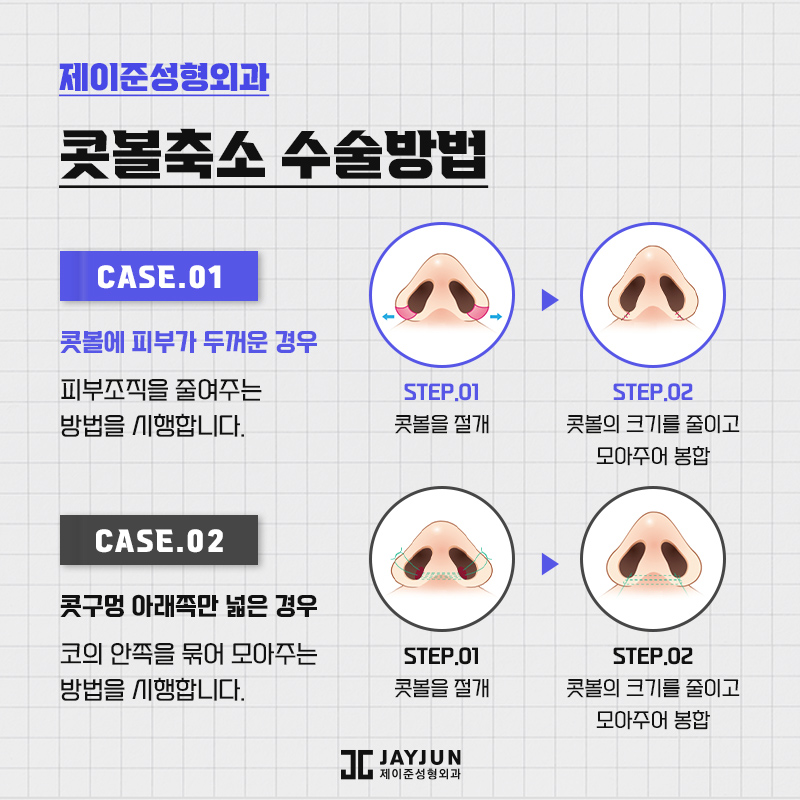 제이준의 비절개콧볼축소 , 콧볼축소 차이점 관련 이미지 7