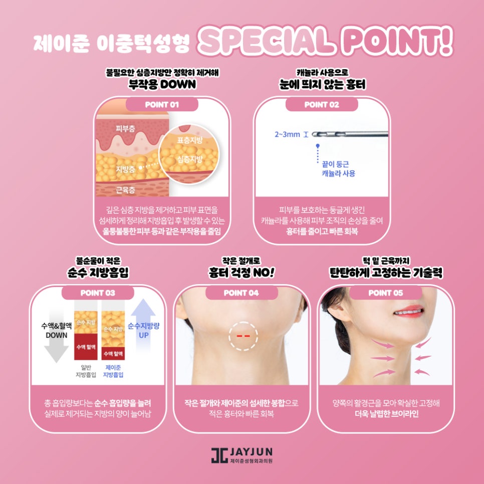 한번에 확실하게! 제이준 이중턱 지방흡입 & 근육묶기 관련 이미지 8