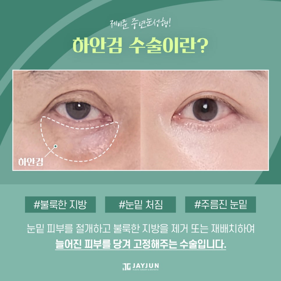[제이준성형외과] 매끈하고 탄력있는 눈 밑으로! 중년눈성형 하안검 관련 이미지 3