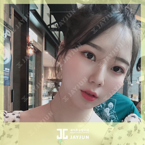 울쎄라 비용 가격 알아보는 방법 관련 이미지 5
