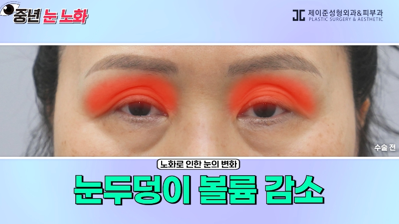 [제이준성형외과&middot;피부과] 🚨성형외과 전문의가 알려주는 눈 노화 신호🚨 관련 이미지 13
