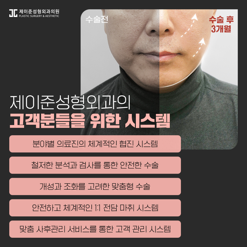 최소절개안면거상술 어떤 수술일까? 관련 이미지 8