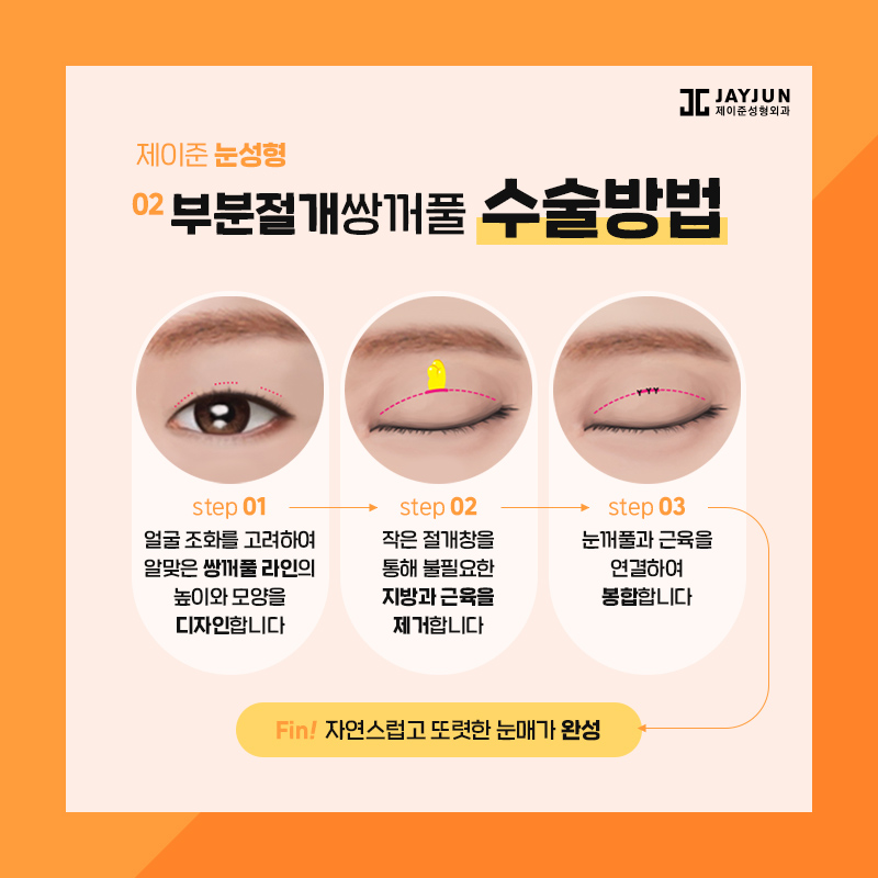 쌍꺼풀수술 종류 알아보기 관련 이미지 5
