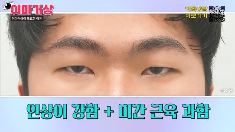 [제이준 유튜브] 쌍수 하러  갔는데 이마거상을 추천하는 이유?! 관련 이미지 11