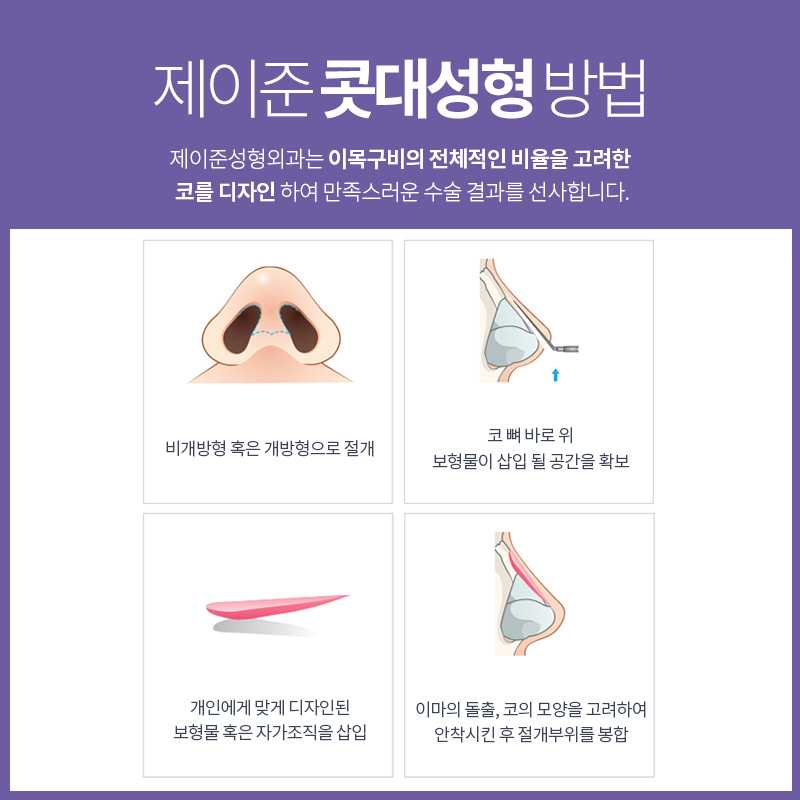 제이준성형외과│콧대성형 ! 관련 이미지 6